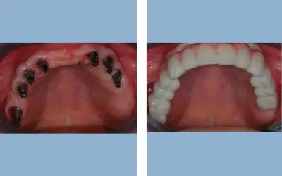 Before and After